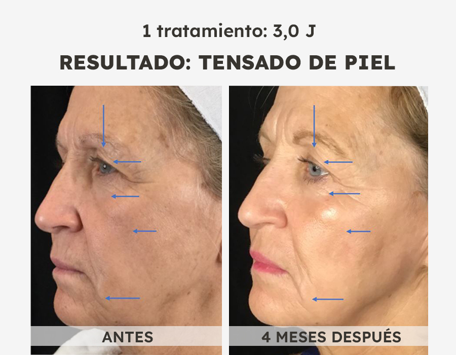 NeoGen caso 1 neogen
