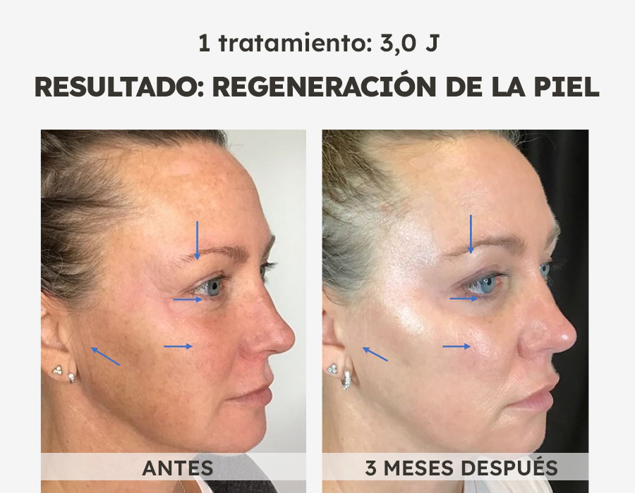 NeoGen caso 4 neogen