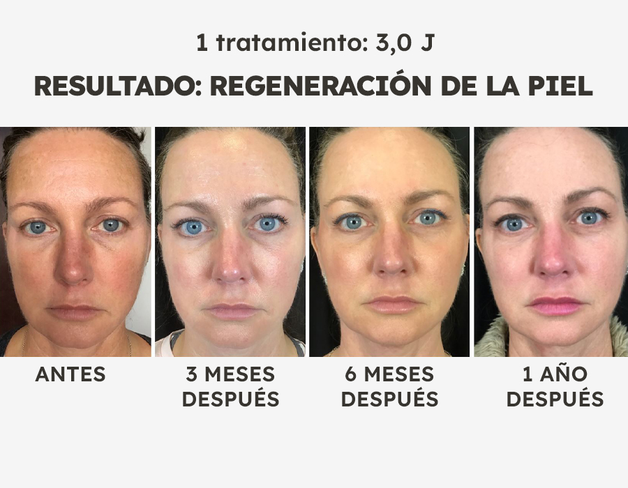 NeoGen caso 5 neogenok